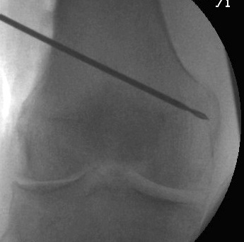 Distal Femoral Osteotomy Guide wire